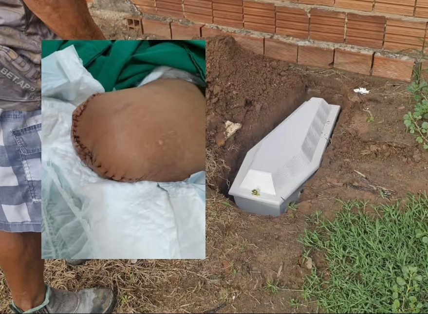 10 dias após enterro, hospital liga para família buscar perna de jovem morto em acidente