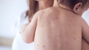 Mato Grosso confirma 28 casos e seis mortes por meningite em 2026